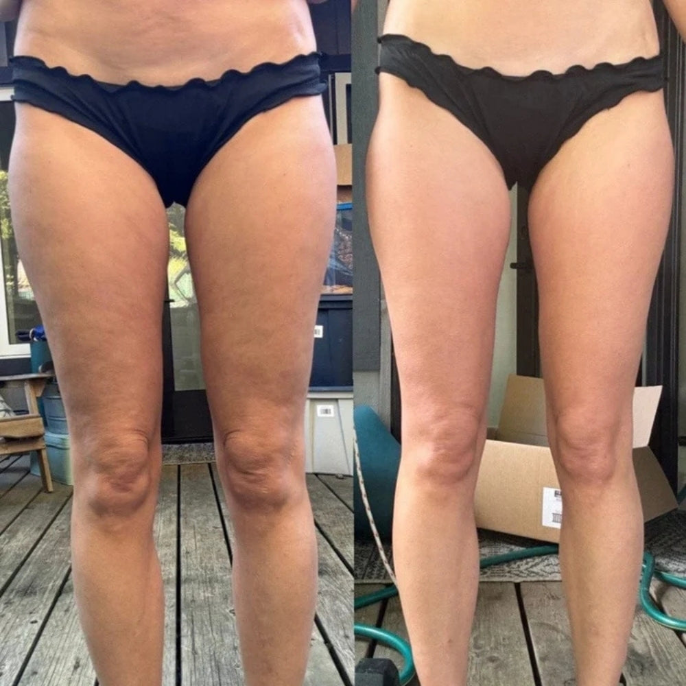 RevivaCupp™ - Cellulite & Circulation Boost Massager